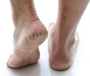 Gót chân nứt nẻ gây khó chịu
